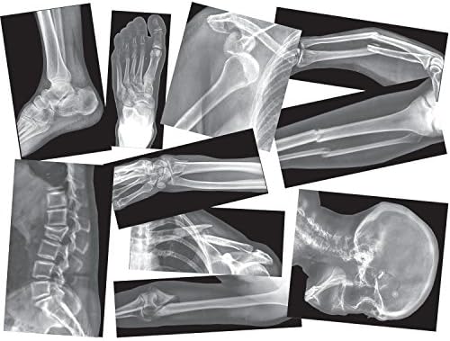 Skup x-Ray slike Slomljenih Kostiju Roylco, Kompatibilan s Проекторным Zaslonom, 15 rendgen